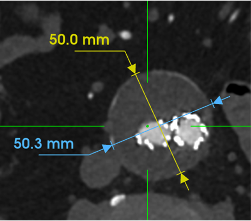 Sac Regression - Dr. John Rollo - After