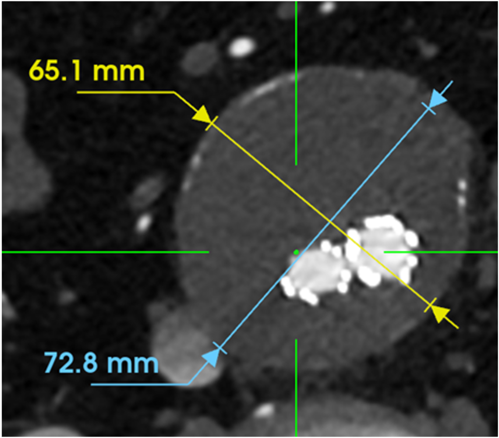 Sac Regression - Dr. John Rollo - Before